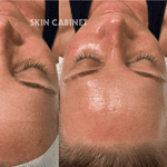 Hydrafacial Before and After - Skin Cabinet