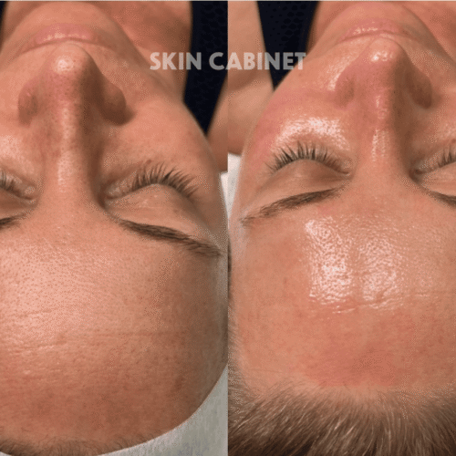 Hydrafacial Before and After - Skin Cabinet