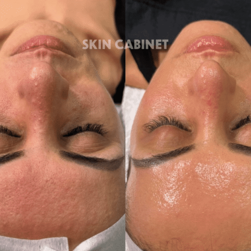 Platinum Hydrafacial - Skin Cabinet - Denton, Tx - best spa in denton