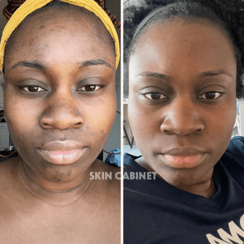 Green Herbal Peel Before and After - Denton Tx- Skin Cabinet