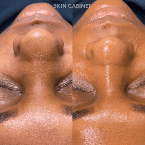 Congested Skin Before and After