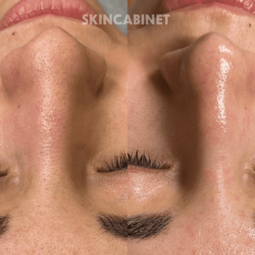 Hydrafacial Before And After