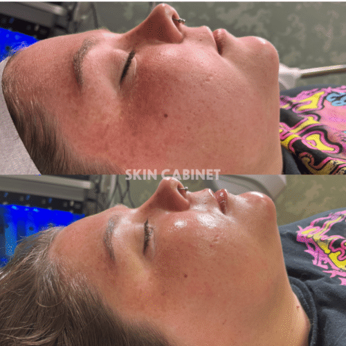 Skin Cabinet - Denton, Tx- Before and After