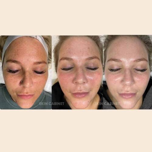 Spa In Denton - Skin Cabinet - Perfect Derma Peel