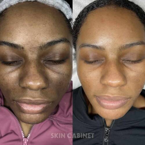 Enlighten Peel In denton texas