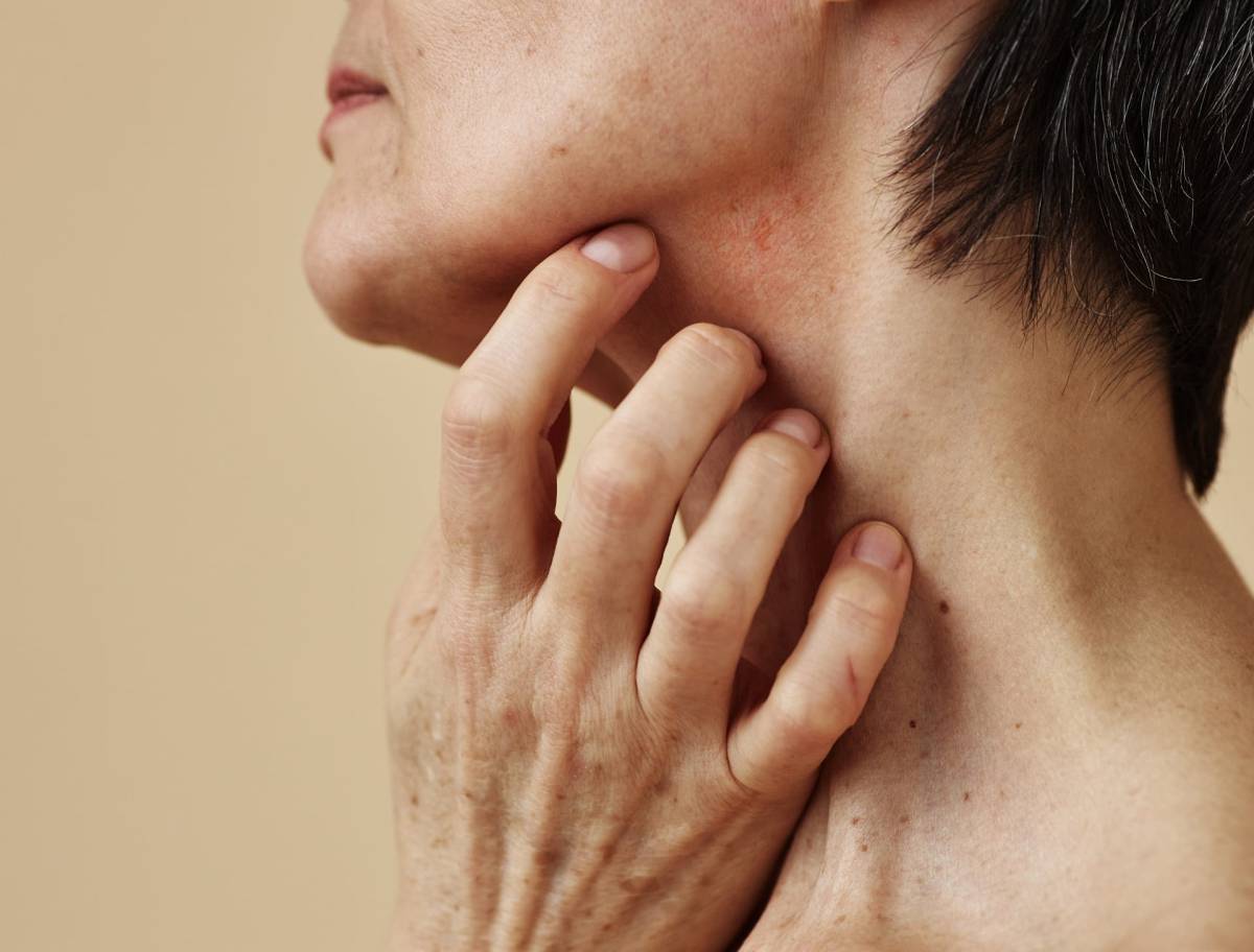 hyperpigmentation