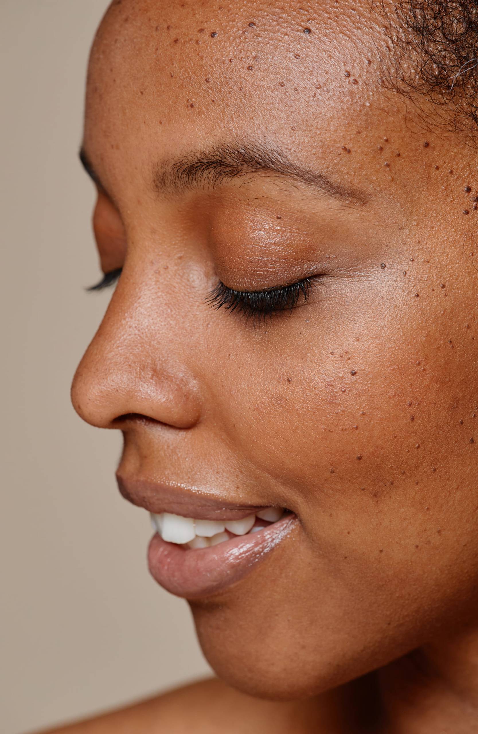 Microneedling