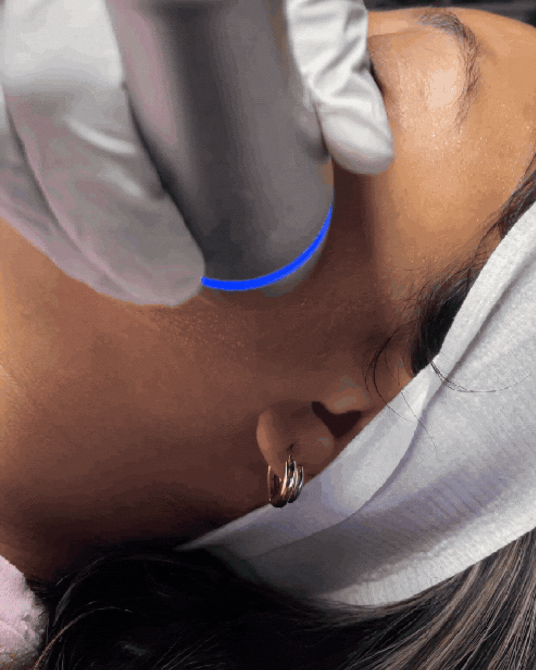 Cryo Facial at SKIN CABINET in Denton Texas