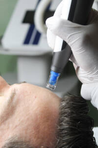 Microneedling at SKIN CABINET in Denton, Texas