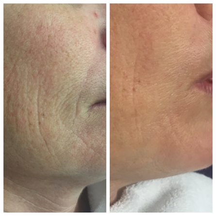 Fine lines and wrinkles Before & After